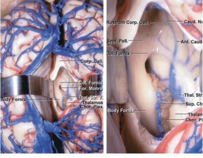 Figura 4: Visão superior da fissura interhemisférica. O lobo frontal direito é retraído lateralmente para expor os ramos bilaterais de artéria cerebral anterior distal (A.C.A.) e o caloso corpus, que é branco brilhante em comparação com o córtex cingulado (imagens superiores).  Os cortices da cingula bilateral podem ser muito aderentes uns aos outros e podem ser confundidos com o corpus calosum.   

A artéria calisomarginal pode ser usada como um roteiro para alcançar as artérias pericallosas. Observe que essa visão (imagem inferior esquerda) foi alcançada sem sacrificar nenhuma veia de ponte, mas em vez disso, desamarando-as de suas membranas aracnoides circundantes. A calisotomia permite a exposição do ventrículo (imagem inferior direita)(Imagens cortesia de AL Rhoton Jr).
