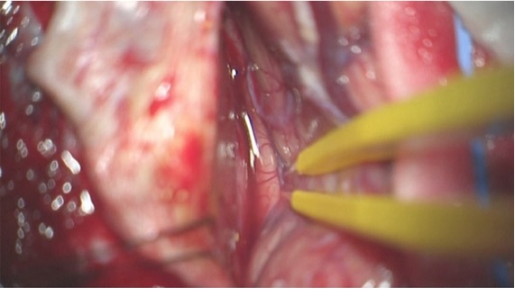 Figura 11: A porção subdural da dissecação é completada ao longo do falx e a artéria calisomarginal ipsilateral é traçada ao longo da linha média até o nível do cingulum (imagem superior). Esta artéria definirá os planos de dissecção da linha média para que o cirurgião possa evitar lesões subpiais nos cortices aderentes da cingula através de técnicas microcirúrgicas meticulosas e afiadas (imagem inferior).