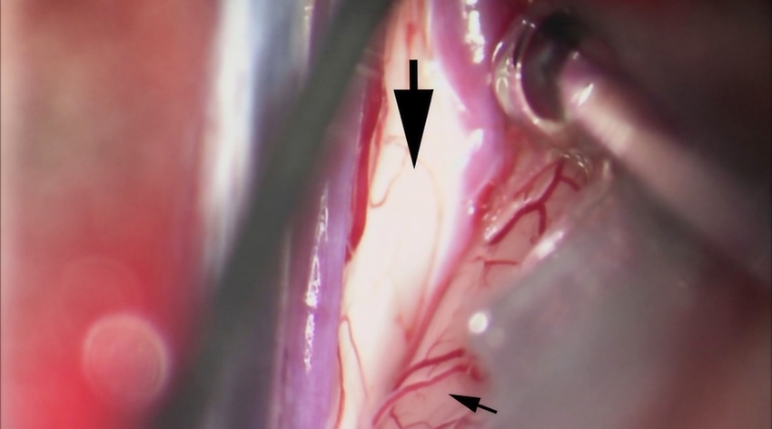 Figura 12: Observe a diferença de cor entre o giro cingulado (seta pequena) e o caloso corpus (seta grande). Cortices cingulados muito aderentes podem ser confundidos como corpus calosum. O caloso corpus é branco brilhante e se destaca do tecido cortical circundante. A liberação de CSF do ralo lombar facilitará essa dissecção interhemisférica. O operador deve observar as artérias pericallosas e evitar feri-las inadvertidamente com a ponta dos microscisores.