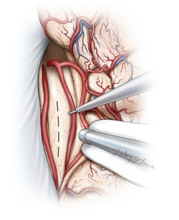 Figura 13: O caloso corpus é amplamente exposto na linha média entre as artérias pericallosas emparelhadas. As membranas aracnoides aderentes da cingula são acentuadas e amplamente divididas anteriormente e posteriormente para minimizar a retração nos hemisférios medial. Às vezes, as artérias pericallosal podem ser deslocadas para um lado ou também podem aderir juntas, dificultando sua separação.