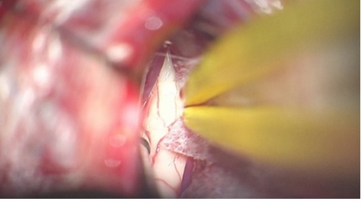 Figura 13: O caloso corpus é amplamente exposto na linha média entre as artérias pericallosas emparelhadas. As membranas aracnoides aderentes da cingula são acentuadas e amplamente divididas anteriormente e posteriormente para minimizar a retração nos hemisférios medial. Às vezes, as artérias pericallosal podem ser deslocadas para um lado ou também podem aderir juntas, dificultando sua separação.